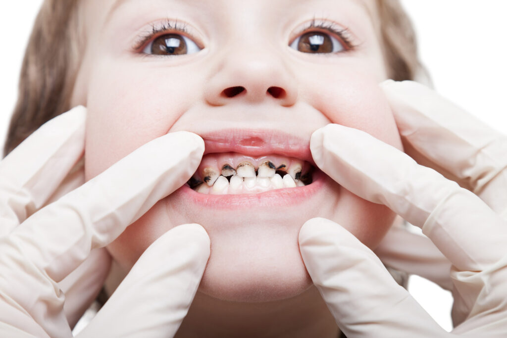 How Tooth Decay Progresses Over Time