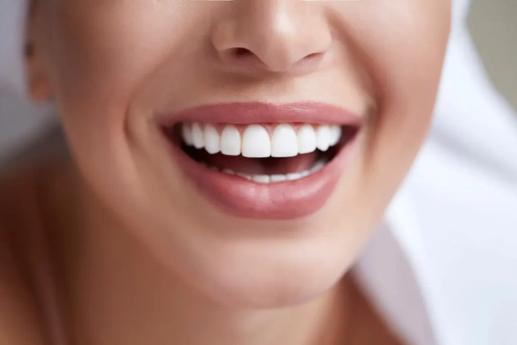 Porcelain Veneer Maintenance Tips