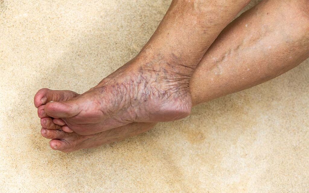 Demystifying Varicose Veins: The Anatomy Unveiled