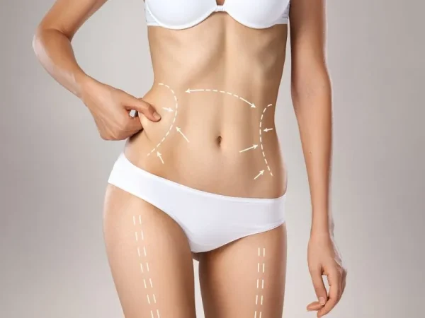 Laser Lipo