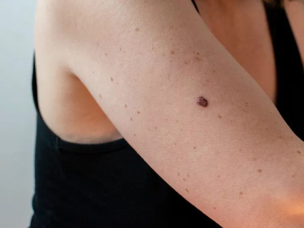 skin cancer specialists