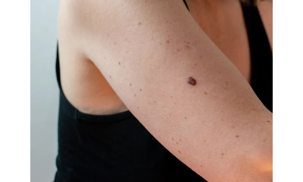 skin cancer specialists