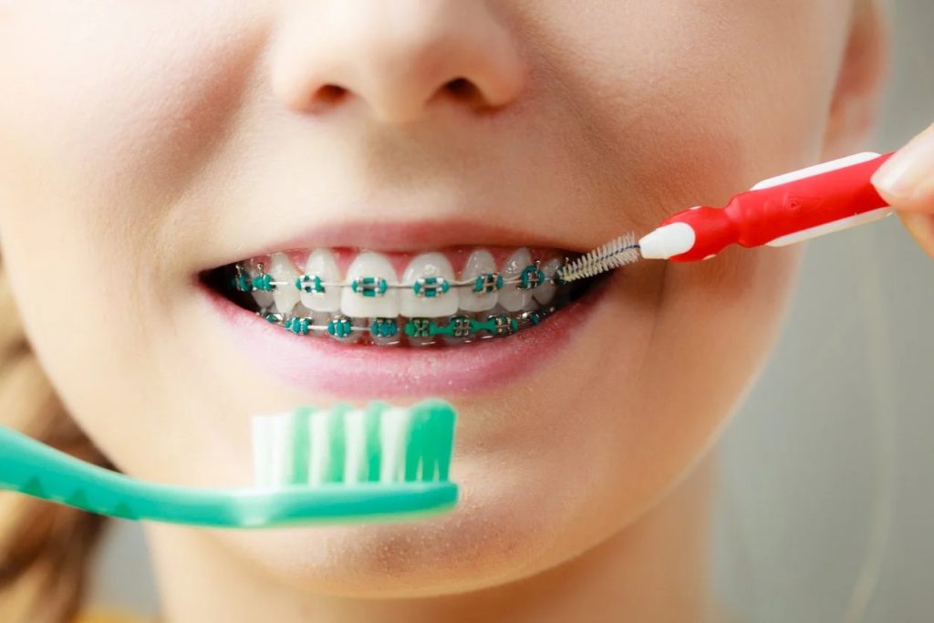 A Short Guide to Must-Have Tools for Cleaning Your Braces