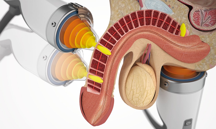 Shockwave Therapy for ED