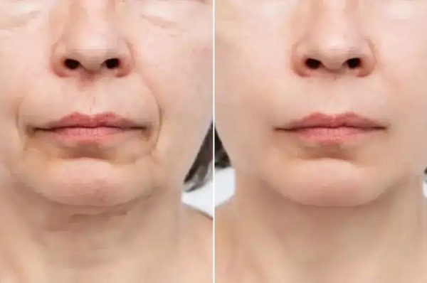 Transformative Facial Changes: Rhytidectomy And the Pursuit of Natural Results