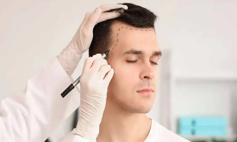 Hair Transplant Price in Turkey: What Are Patients Actually Paying For?